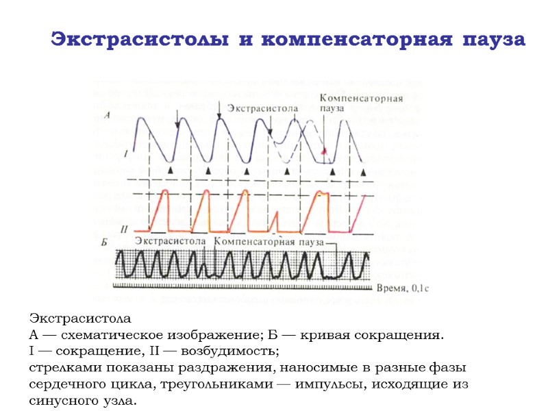Экстрасистолы и компенсаторная пауза Экстрасистола А — схематическое изображение; Б — кривая сокращения. 
